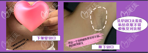 隆胸切口隱痕幾乎看不出
