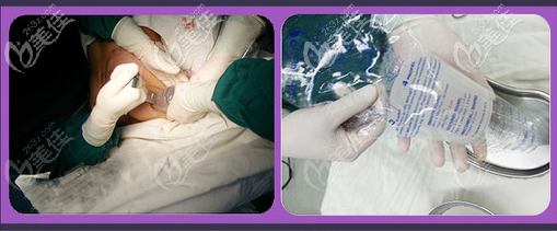 非接觸傳送假體技術(shù)