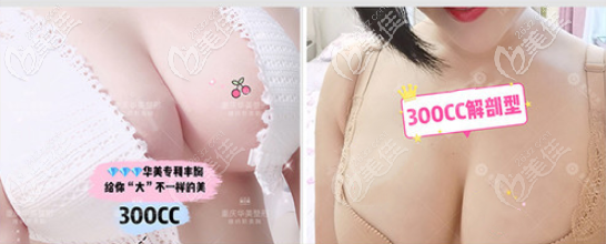 重慶華美300cc傲諾拉假體隆胸效果圖