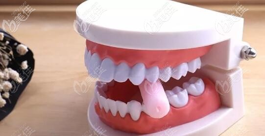 隱形矯正中咬膠棒有什么作用