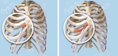 仇侃敏做肋骨鼻子的優(yōu)勢