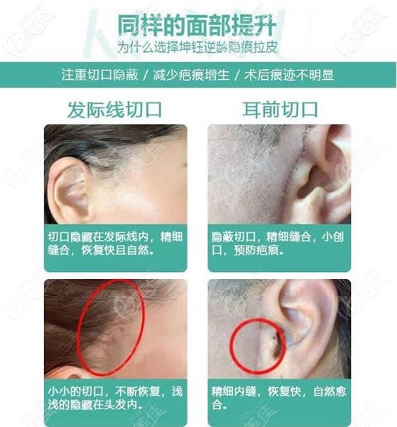 <!--<i data=20240703-sp></i>-->整形小切口手術(shù)切口 <!--<i data=20240703-sp></i>-->整形小切口手術(shù)切口