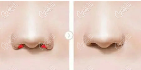 鼻翼下垂矯正手術
