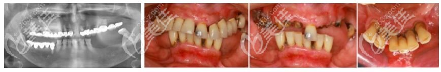 術(shù)前無牙頜老人口腔情況 術(shù)前無牙頜老人口腔情況