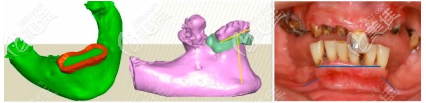 老人種植牙方案設(shè)計 老人種植牙方案設(shè)計
