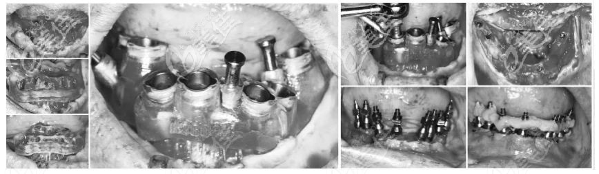 即刻負(fù)重種植牙手術(shù)過程 即刻負(fù)重種植牙手術(shù)過程