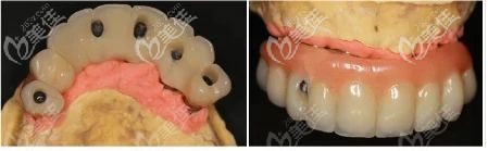 種植義齒制備 種植義齒制備