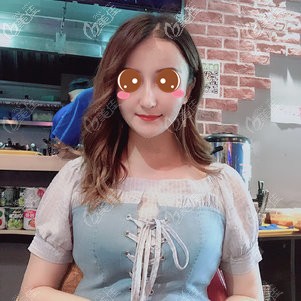 武漢壹加壹做的PPDO全面部線提升效果不錯，1周消腫，20天做表情不僵硬