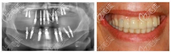 老人戴臨時冠 老人戴臨時冠