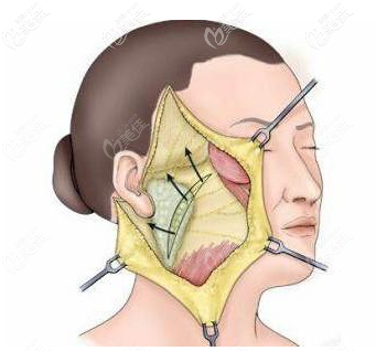 風(fēng)箏小切口拉皮優(yōu)勢(shì)