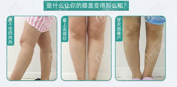 膝蓋抽脂可以單獨做嗎