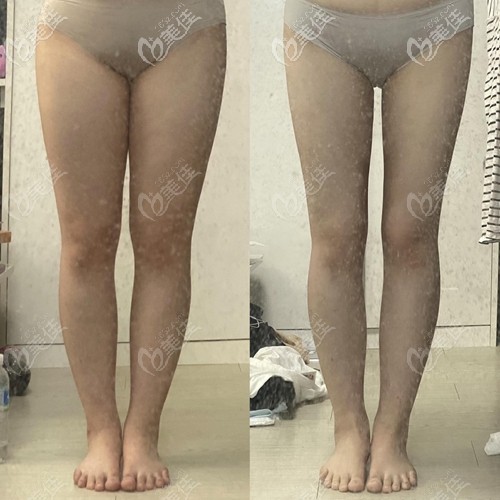 無限蘭斯吸脂瘦大腿前后對比 無限蘭斯吸脂瘦大腿前后對比