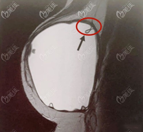 假體破裂在乳腺核磁下的狀態(tài)