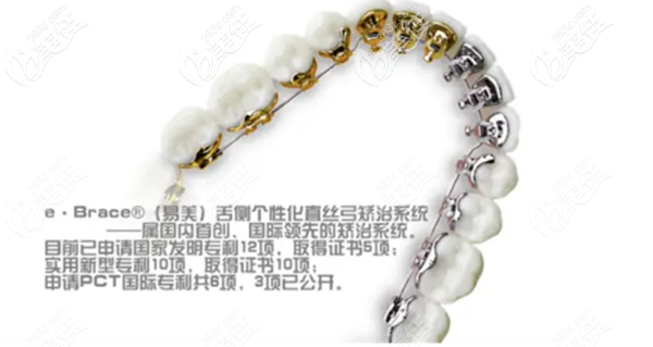 馬瀧齒科的eBrace舌側(cè)托槽矯正