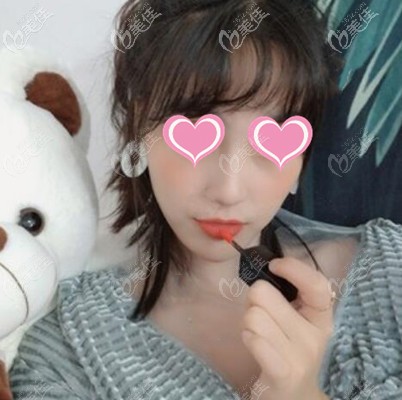 快翎線提升術(shù)后1個(gè)月效果 快翎線提升術(shù)后1個(gè)月效果