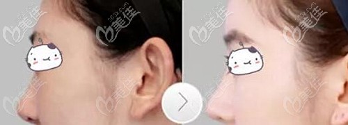 仇侃敏醫(yī)生隆鼻案例