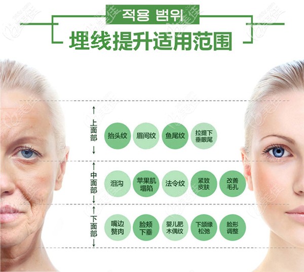 埋線提升使用范圍 埋線提升使用范圍