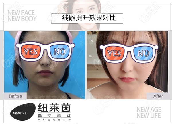 <!--<i data=20240703-sp></i>-->埋線提升案例效果圖 <!--<i data=20240703-sp></i>-->埋線提升案例效果圖