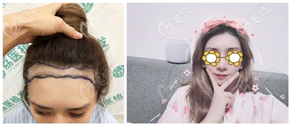 女子植發(fā)一年的真實案例:沒想到植發(fā)際線2000單位的效果會這么明顯