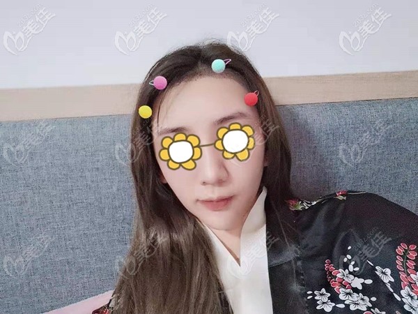 廣州荔醫(yī)植發(fā)醫(yī)院-尚俊醫(yī)生植發(fā)案例