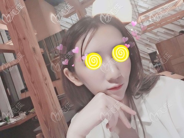 看我在廣州荔醫(yī)植發(fā)一個(gè)月效果圖