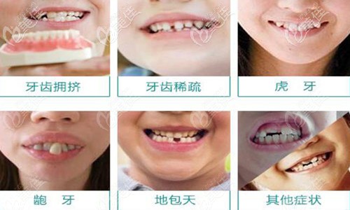 牙齒畸形圖 牙齒畸形圖