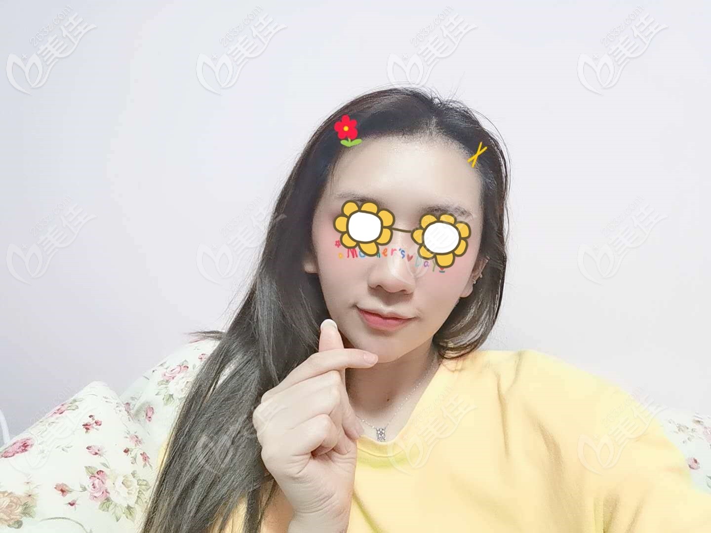 發(fā)際線植發(fā)2000單位2個(gè)月的效果圖