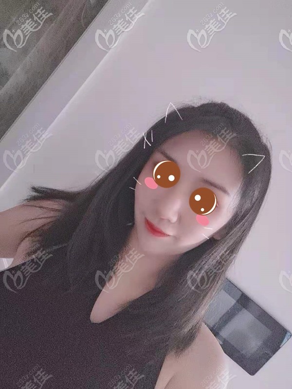 廣州荔醫(yī)尚俊醫(yī)生植發(fā)半年后的效果圖片