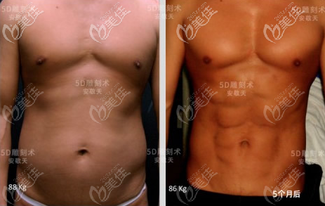 韓國麗迪安5D吸脂雕刻術(shù)塑造男士八塊腹肌效果圖