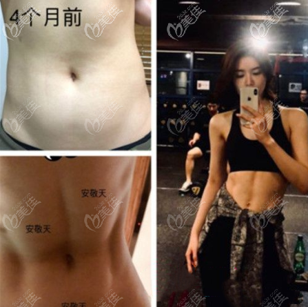 5D脂肪雕刻術(shù)塑造女性馬甲線效果圖
