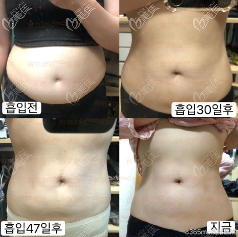 韓國365mc蘭斯吸脂瘦腰腹效果圖