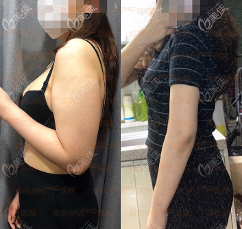 蘭斯吸脂瘦手臂效果圖