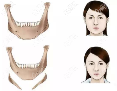 長(zhǎng)曲線下頜角費(fèi)用