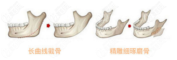 長(zhǎng)曲線下頜角截骨對(duì)比圖