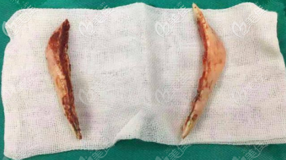 長(zhǎng)曲線下頜角截骨手術(shù)截骨圖片