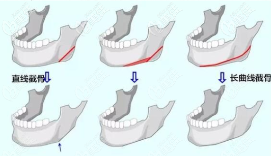 長(zhǎng)曲線下頜角截骨