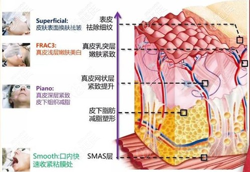 fotona4D面部提升原理