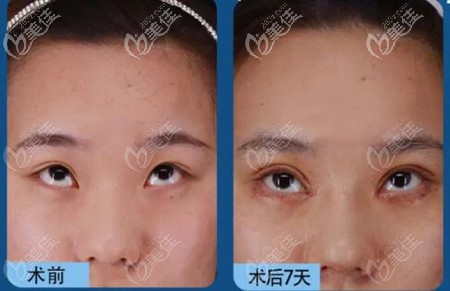 曲學(xué)延點(diǎn)式重瞼雙眼皮案例