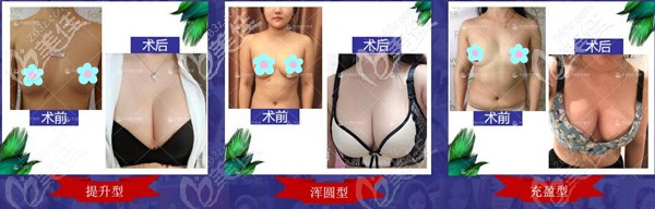 成都恒博天姿李烈院長(zhǎng)隆胸案例集合