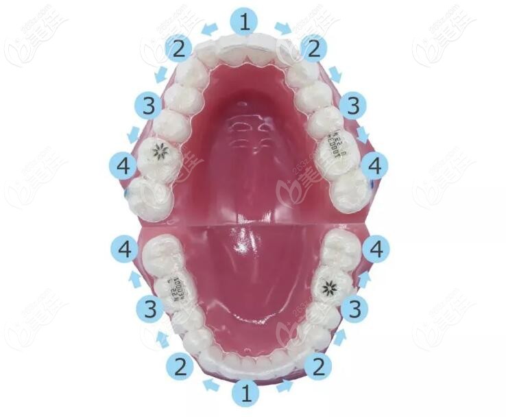 隱適美牙套的佩戴方式