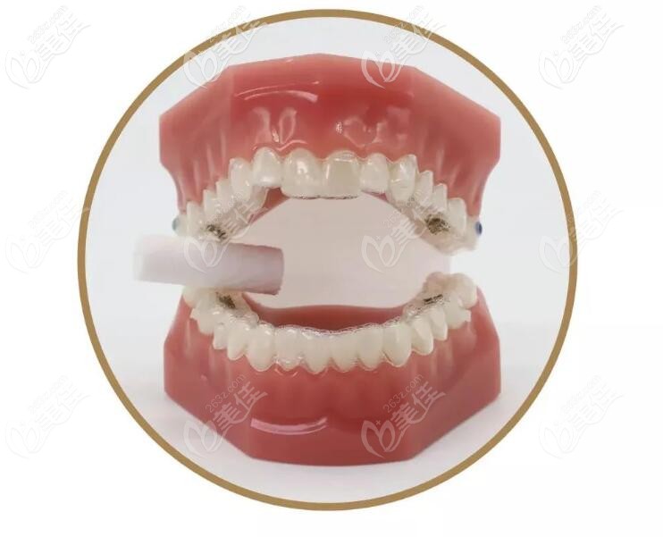 帶牙套的時候記得要咬膠哦