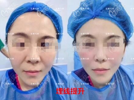 大連達(dá)美元辰醫(yī)療美容做埋線提升真人前后對比照