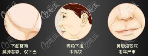 DM小切口動(dòng)態(tài)記憶面部提升術(shù)相關(guān)適應(yīng)癥