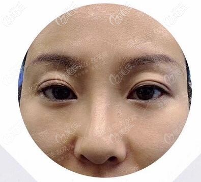 眼修復(fù)術(shù)前照 眼修復(fù)術(shù)前照