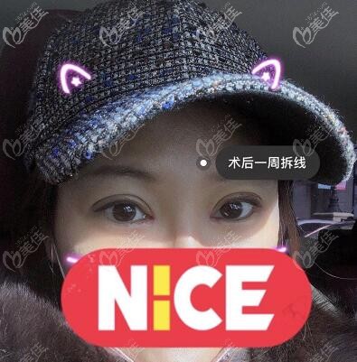 眼綜合修復(fù)術(shù)后一周拆線 眼綜合修復(fù)術(shù)后一周拆線