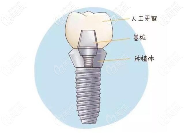 種植牙結構示意圖 種植牙結構示意圖