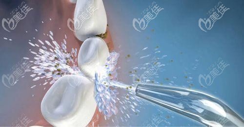 洗牙的圖片 洗牙的圖片