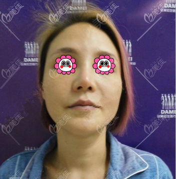 我做面部提拉術前照 我做面部提拉術前照