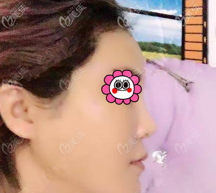 面部提拉多少錢?我在北京達(dá)美如藝做深淺雙層全面部提升花3萬多