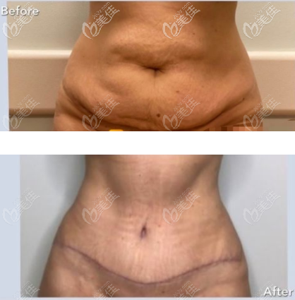 成功的腹壁成形術(shù)前后對比圖片